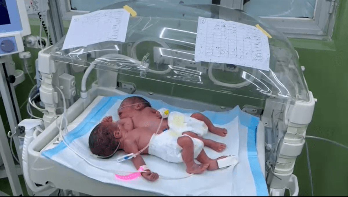 ئەو دوو منداڵەی پێکەوەنووسابوون یەکێکیان مرد و ئەوەی دیکە لێی جیاکرایەوە